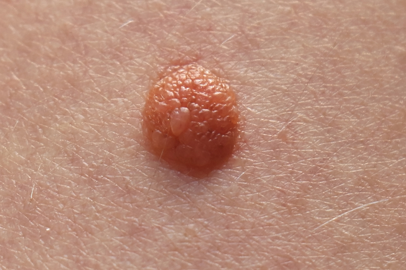 Moles or Melanocytic nevus