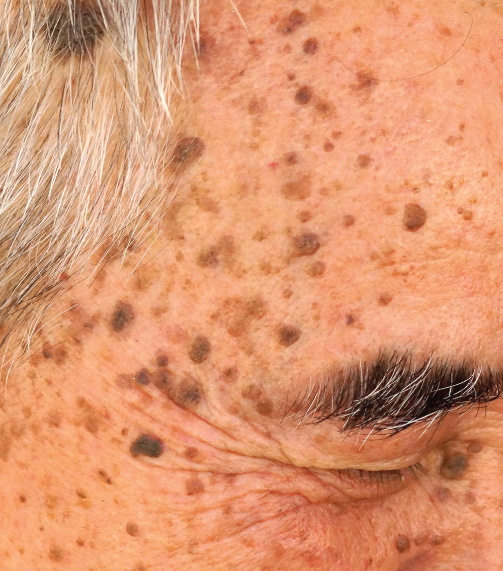 Brown Spots - Mayoral Dermatology