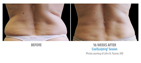 Coolsculpting, Treatments, Clínica DermAge