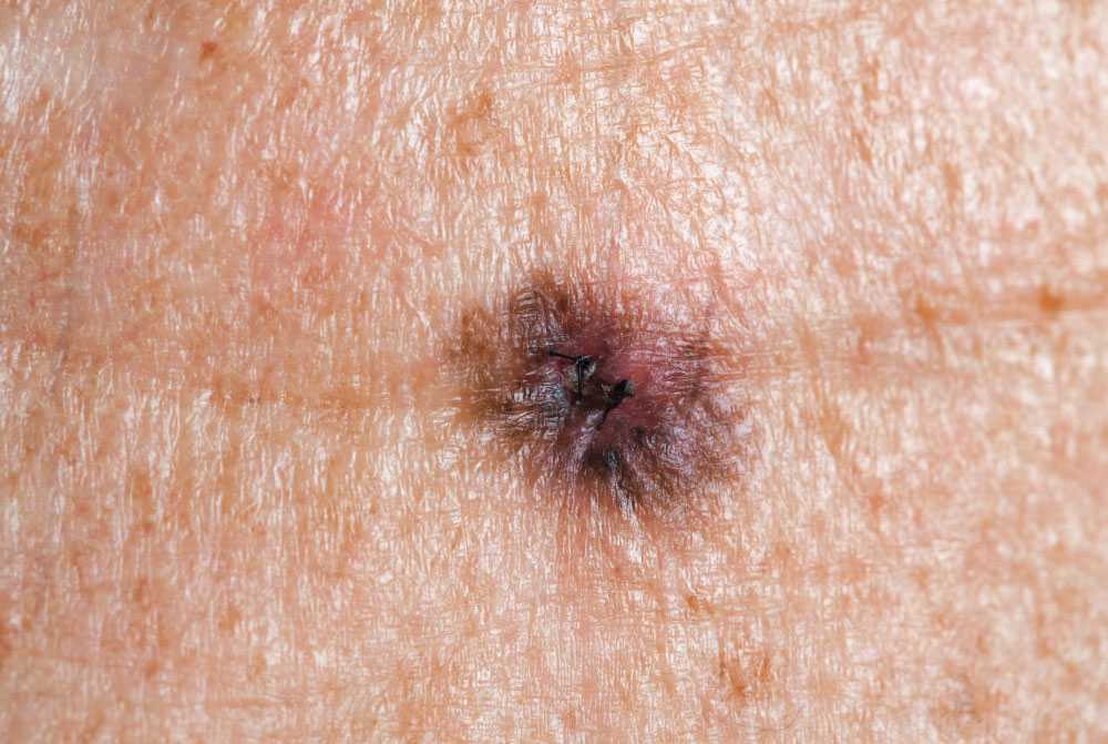 Melanoma 