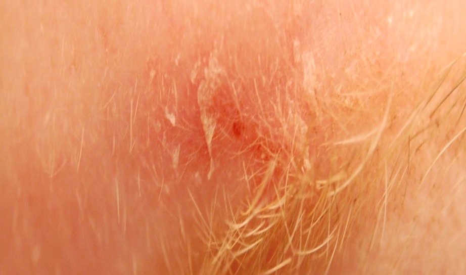 Epidermoid Cyst